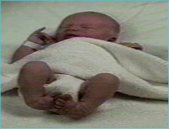 clubfoot treatment