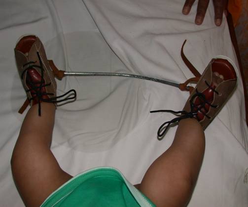 clubfoot treatment