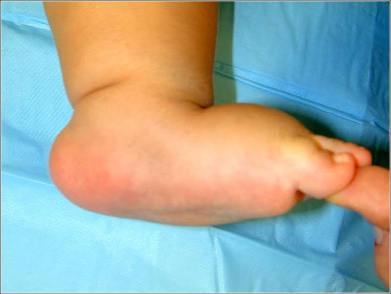 congenital vertical talus