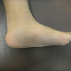 flat feet