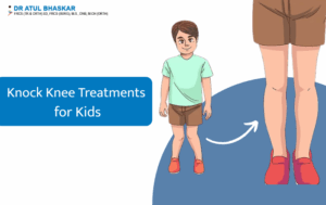 Effective Treatments for Knock Knees in Growing Children