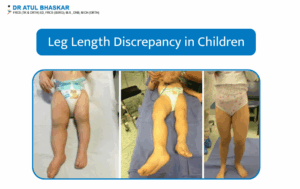 Leg Length Discrepancy in Children: Causes and Treatments