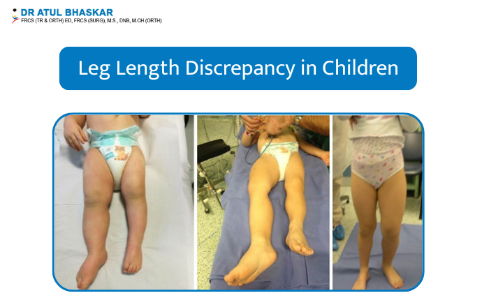Leg Length Discrepancy in Children: Causes and Treatments