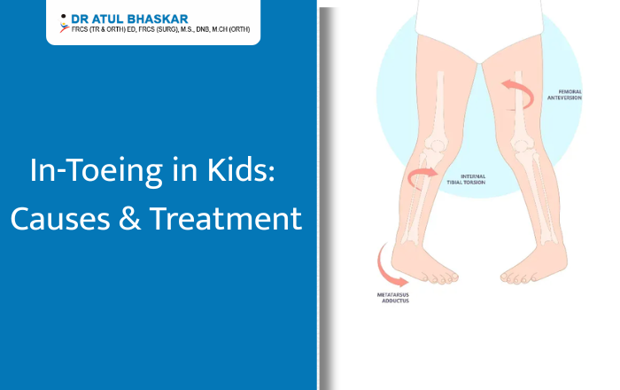 Pigeon Toes in Children: What Causes In-Toeing and How to Treat It