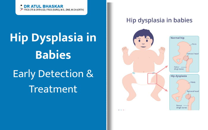 Hip Dysplasia in Babies: Early Identification & Treatment Guide for Parents