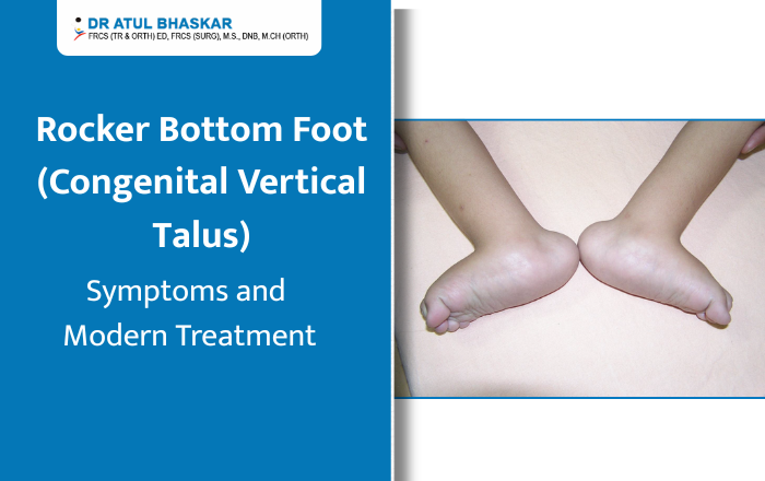 Rocker Bottom Foot (Congenital Vertical Talus): Symptoms and Modern Treatment
