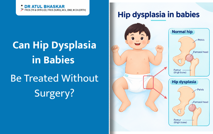 Can Hip Dysplasia in Babies Be Treated Without Surgery?